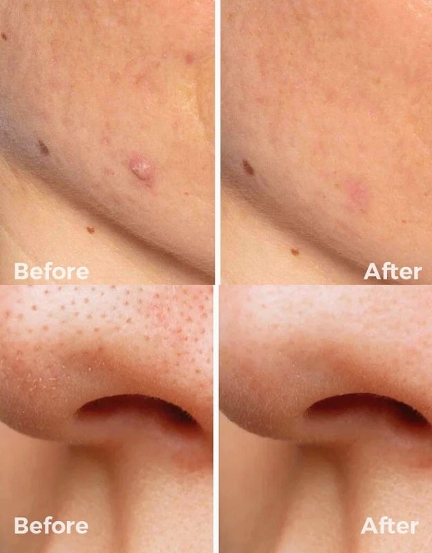 Skin before and after using electric face vacuum pore cleaner for acne and pore cleansing.