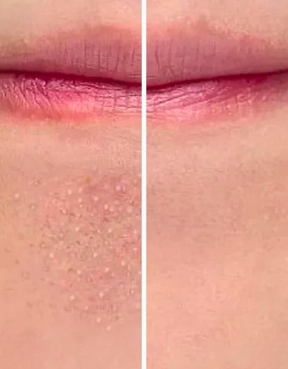 Visible results on chin and lip area after using electric face vacuum pore cleaner with suction heads.